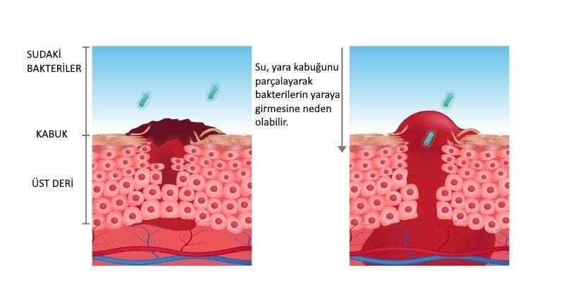 Açık Yara ile Havuza Girilir mi?